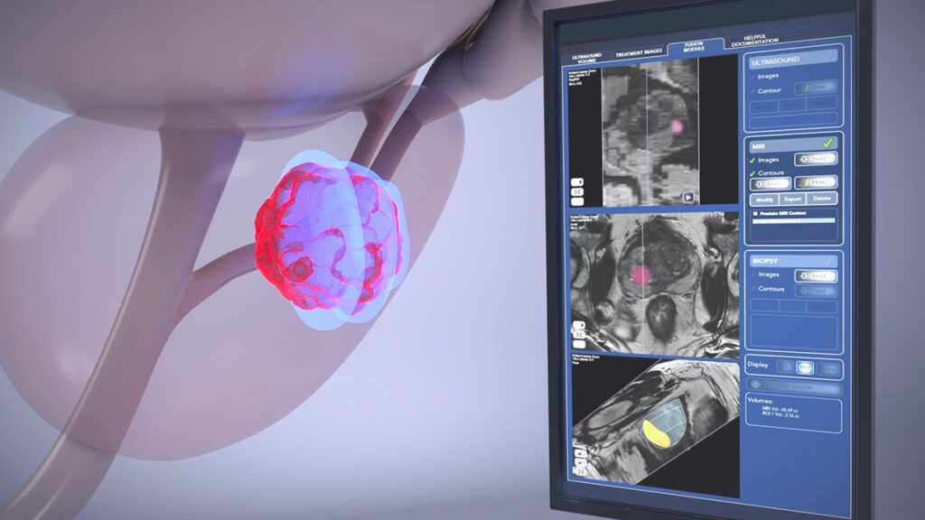 Cleveland Clinic London First to Offer Robotic Focal HIFU in England